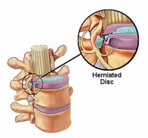 Image showing zoomed part of the herniated disc.