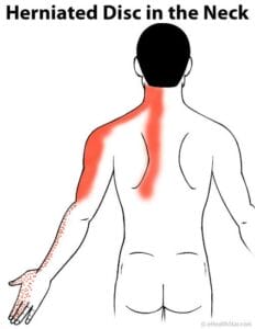 The image highlights the pain radiated area in the human body in case of a herniated disc in the neck.