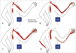 The image highlights the pain radiated depending on which cervical disc is herniated.