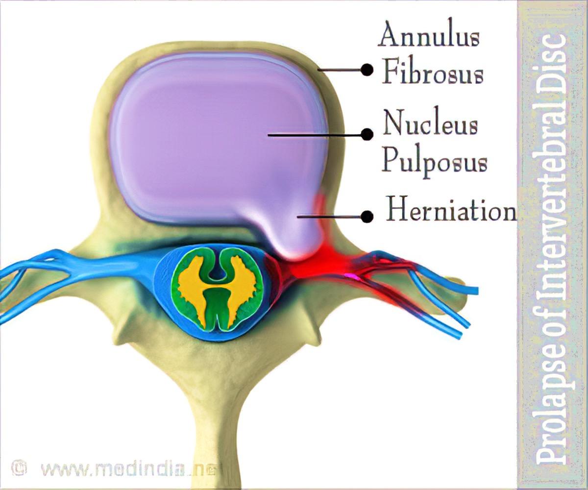 Image of prolapsed intervertebral disc showing herniation.