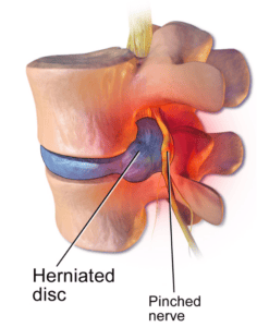 A Part of the vertebral column showing herniation and a pinched nerve.