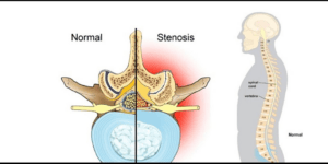 Image showing compared image of normal state and stenosis state of spine.