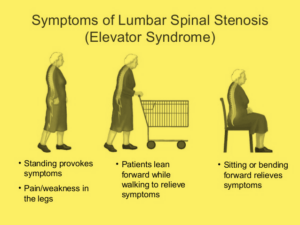 Symptoms of lumbar spinal stenosis/elevator syndrome are shown in the image.