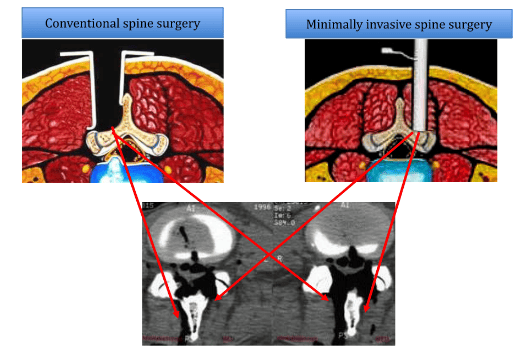 Collage image of two methods of spine surgery compared with x-ray images.