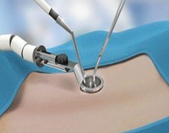 The image illustrates a minimally invasive spine surgery.