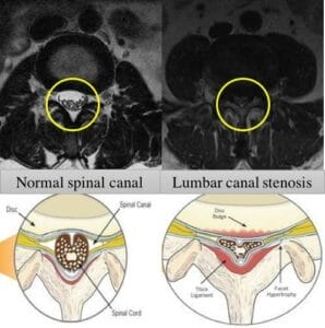 Image showing normal spinal canal & lumbar canal with stenosis.