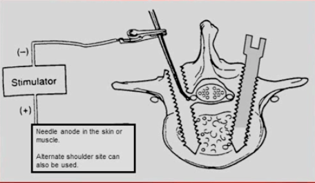 The image illustrates Intraoperative Neuromonitoring.