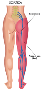 The image highlights the area of pain caused by sciatica in red and the sciatica nerve in blue color.