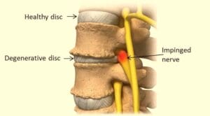 Image showing Healthy disc, degenerative disc and impinged nerve.