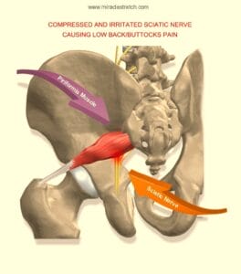 Image highlighting compressed and irritated sciatic nerve causing low back/buttocks pain.