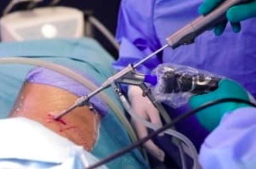 Image of surgeons performing endoscopic spine surgery.