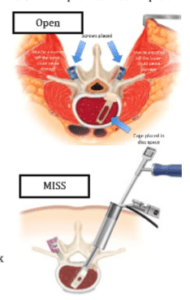 Image depicting the procedures of a open spine surgery and minimally invasive spine surgery.