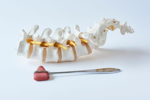Image of artificial human lumbar spine model and reflex hammer.
