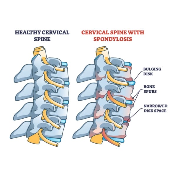A labeled image of cervical spondylosis.