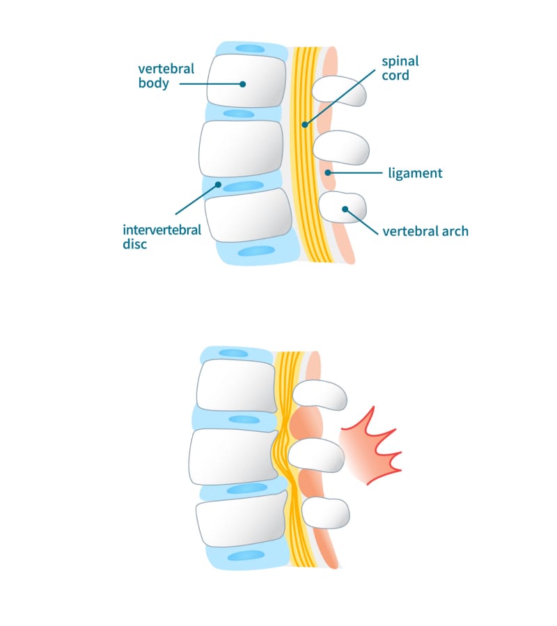A collage image of the Lumbar spine with parts labeled illustrates lumbar canal stenosis treatment.