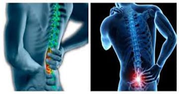 X-ray image illustrates low back pain which is highlighted in red for Lumbar-spondylosis.