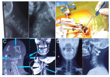 An X-ray image of 3D navigated MIS Atlantoaxial fusion procedure with related imaging.