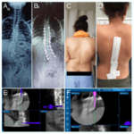 Spinal deformity correction