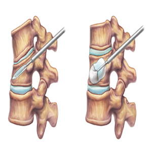 Pictorial illustration of Balloon Kyphyoplasty procedure.