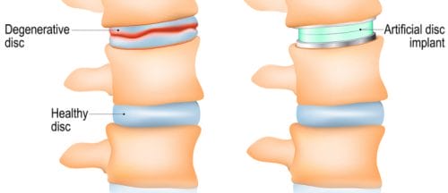 The pre and post-surgical images of the artificial cervical disc replacement.