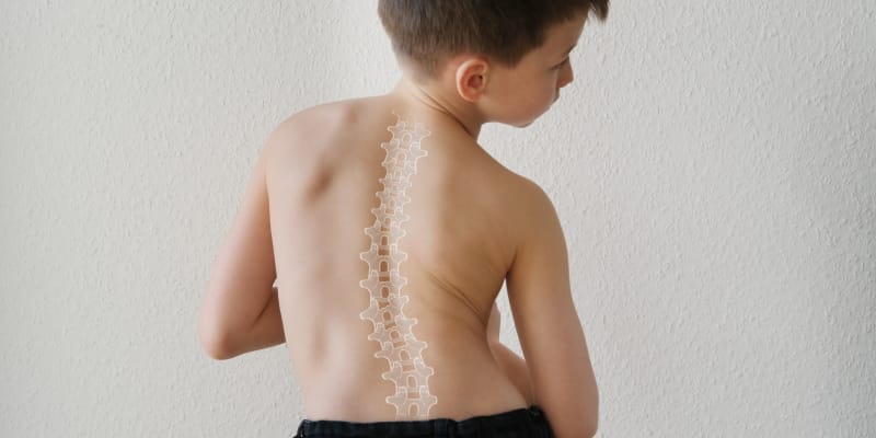 Young boy with scoliosis, showing a curved spine from the back.