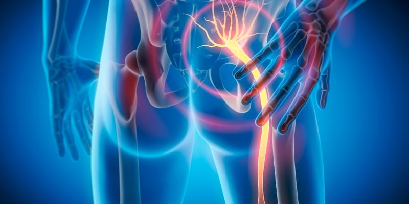 An anatomical illustration of the sciatic nerve showing pain radiating down the leg, used to identify which sciatica exercises to avoid during recovery