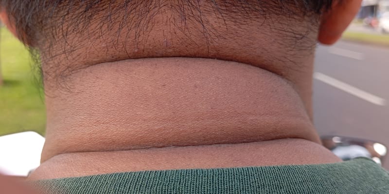 Close-up of horizontal skin folds and adipose tissue on the back of the neck indicating a postural neck hump.